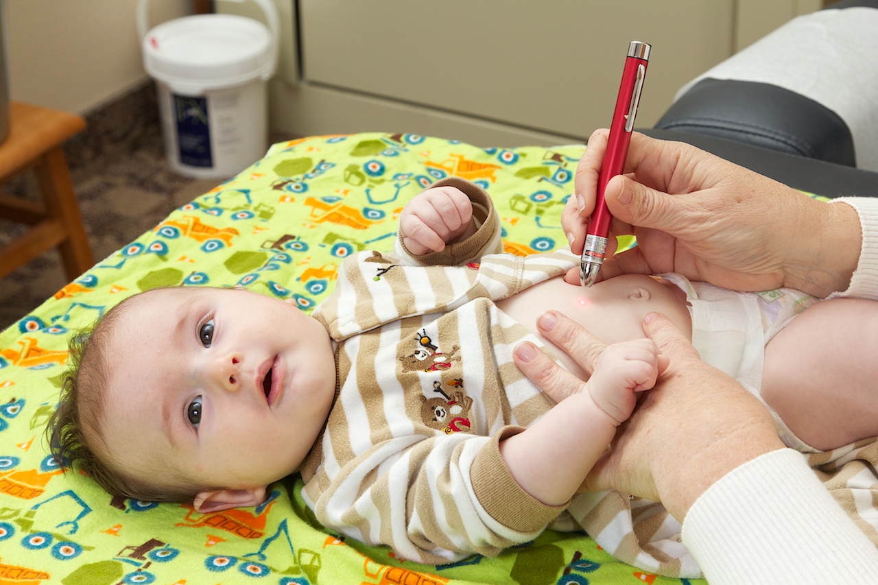 Laser Acupuncture For Neonatal Abstinence Syndrome